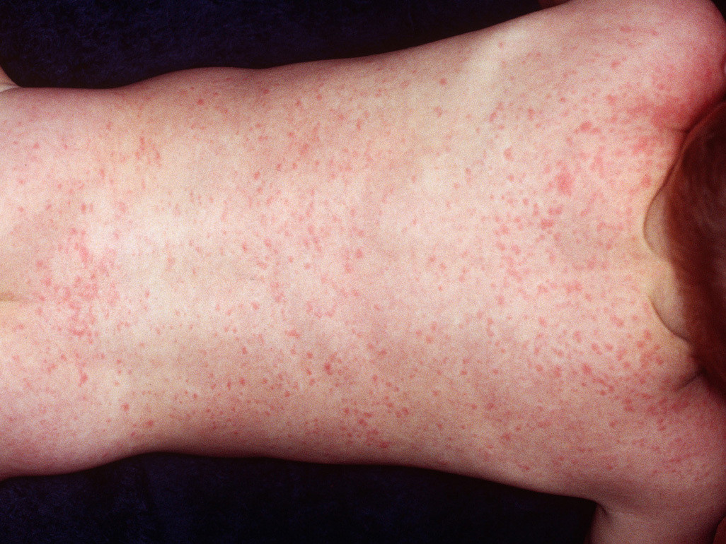 Roseola Infantum